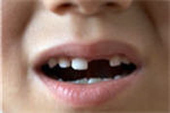 Dent cass&eacute;e : que faire ?