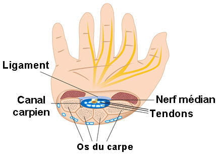 comment guerir syndrome canal carpien