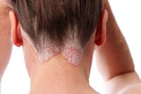 le psoriasis se développe souvent au niveau du cuir chevelu.