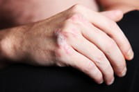 le stress est un des facteurs pouvant faire apparaître des plaques de psoriasis.