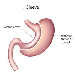 Schema pose anneau gastrique