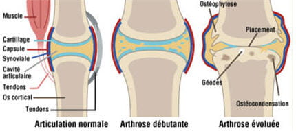 evolution d'une articulation arthrosique au fil des ans.